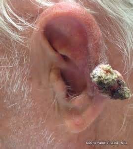 Learn how to spot cancer signs & symptoms so that you can act immediately if something is amiss. Skin Cancer - BASUK DERMATOLOGY