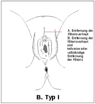 Sie kann schmerzen auslösen und muss gynäkologisch behandelt werden. Frausein in Afrika