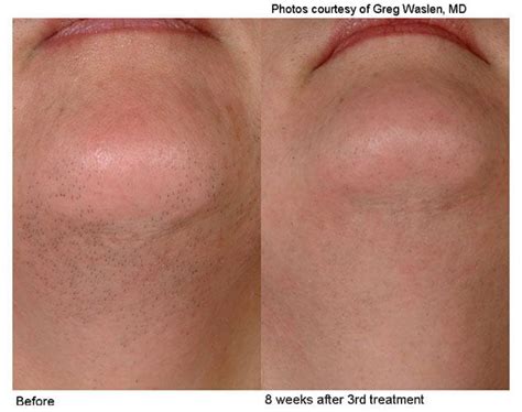 Longer wavelength allows deeper skin penetration. Laser Hair Removal in NYC | Hair Removal for Men & Women ...