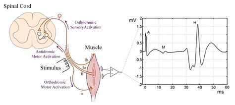 Hoffmann's reflex (hoffmann's sign, sometimes simply hoffmann's, also finger flexor reflex) is a neurological examination finding elicited by a reflex test which can help verify the presence or absence of issues arising from the corticospinal tract. Experimental and Simulated EMG Responses in the Study of ...