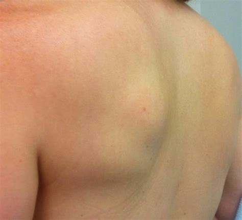 Treating pulled shoulder blade muscle? Lipoma - Pictures, Removal, Treatment, Causes, Surgery ...