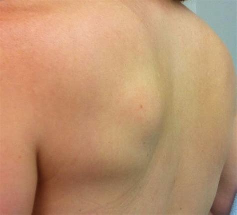 But after the cancer has grown, the national institutes of health says common symptoms include pain near the right shoulder blade or in the back. Lipoma - Pictures, Removal, Treatment, Causes, Surgery ...