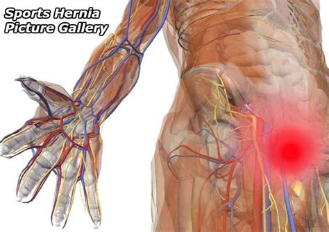 The are of concern in the area where the leg meets the groin, in the fold there. Sports Hernia Picture Gallery - Physiqz