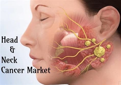 Your larynx, also called your voice box, is at the top of your trachea, or windpipe. Head and Neck Cancer Market Symptoms and Signs Analysis 2026