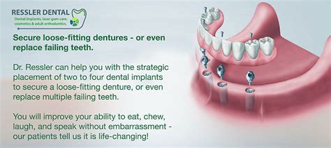 Can a loose tooth be fixed? Secure Loose dentures with dental implants | Delray Beach ...