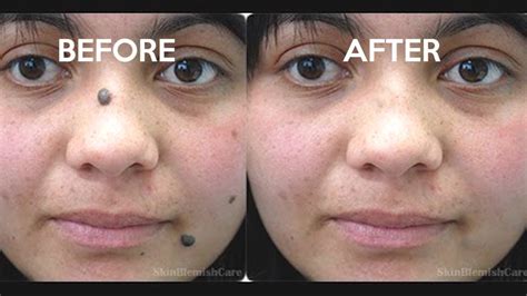 That said, it's perfectly fine to hide a mole on your face or anywhere on your body if you feel like it. 2 Easy Ways To Remove Moles From Your Face | How To Get ...