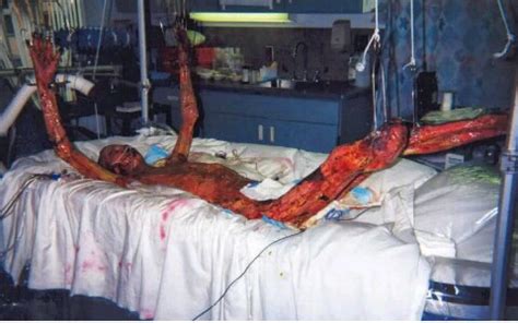 Those who attended the plant when it first exploded suffered from radiation (image: What Radiation Can Do To Body. Warning Highly Graphic photo - Health - Nigeria