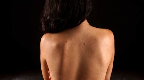 Check spelling or type a new query. How to Banish Back and Chest Acne - Treatments for Body ...