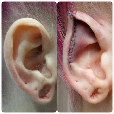 Prevent a pixie ear deformity, the authors use the flap routinely for earlobe shape. ear pointing - Szukaj w Google | Body mods, Body piercings ...