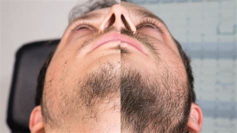 Das Minoxidil Experiment