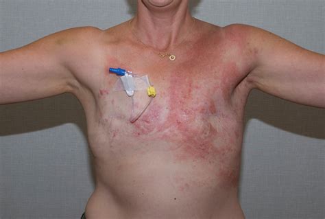 This occurs because inflammatory breast cancer blocks lymphatic drainage and skin gets a somewhat swollen or inflamed look. Inflammatory breast cancer | Sweden | PDF | PPT| Case ...