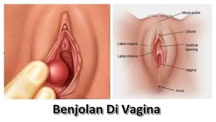 Ada dugaan bahwa benjolan yang ada di bagian bawah rahang adalah disebabkan oleh lipoma. Sehat Itu Barokah: Inilah Penyebab Terjadinya Benjolan Di ...