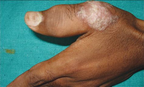 Tuberculosis (tb) is a potentially serious infectious disease that mainly affects the lungs. A clinicopathological study of cutaneous tuberculosis at ...