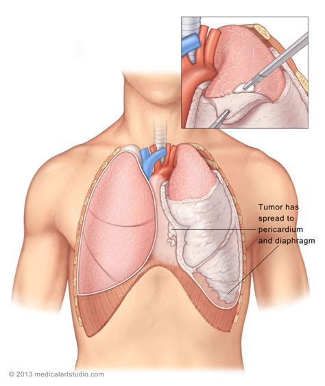 Malignant peritoneal mesothelioma (mpem) is a rare type of cancer with a poor prognosis. Malignant Pleural Mesothelioma | Department of ...