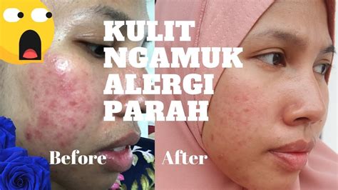 Oleh karena itu banyak yang mencari tahu cara menghilangkan gatal dan membutuhkan obat gatal yang paling ampuh. Cara Mengobati Kulit Alergi, Merah Gatal Jerawat Iritasi ...