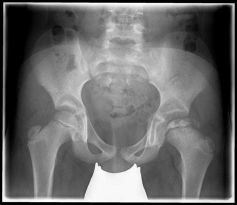 Treatment for perthes focuses on helping the bone grow back into a more rounded shape that still fits into the socket of the hip joint. Hüfte: Morbus Perthes / Roland-Klinik