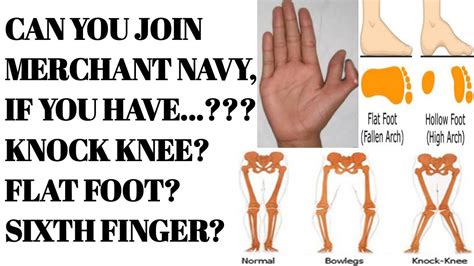 Also because your hips are doing extra work they tend to develop chronic pain eventually as well. CAN YOU JOIN MERCHANT NAVY IF YOU HAVE KNOCK KNEE AND FLAT ...
