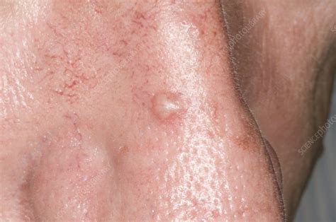 As the above pictures show, this skin cancer tends to develop on skin that has had lots of sun exposure, such as the face or ears. Basal cell carcinoma of the nose - Stock Image - M131/0771 ...