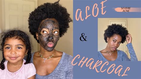 Aloe vera face masks are a combination of aloe vera and various other ingredients. FIGHTING SEVERE ACNE w/ DIY Charcoal and Aloe Vera face ...