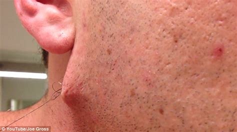 Popular sebum with of good quality and at affordable prices you can buy on aliexpress. Man pulls world's longest ingrown HAIR out of his face ...