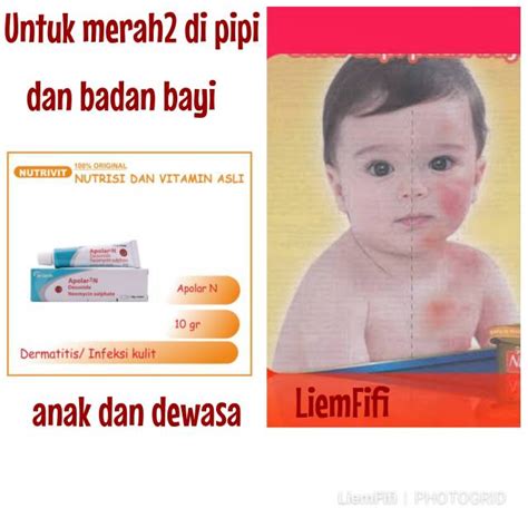 Munculnya bintik merah pada kulit bayi kebanyakan tidaklah berbahaya. Salep Untuk Ruam Susu Pada Pipi Bayi - Info Tentang Susu