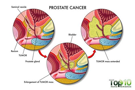 Men were getting treated for prostate cancer even though their cancers were very slow growing and do you know the facts about prostate cancer? Signs and Symptoms of Prostate Cancer that You Must Know ...