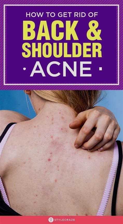 This addition can really speed up healing (see more about tea tree oil and acne here) How To Get Rid Of Back Acne Naturally: 17 Home Remedies in ...