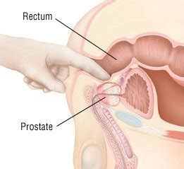For this reason, prostate massagers have been developed to reach the prostate with ease. Chronic Prostatitis Guide: Causes, Symptoms and Treatment ...