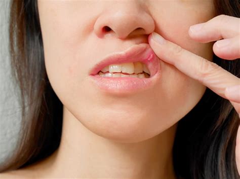 May 12, 2021 · canker sores are small, shallow wounds in your mouth that can make eating and talking uncomfortable. Jangan Remehkan Sariawan Yang Tak Sakit - JoSS.co.id