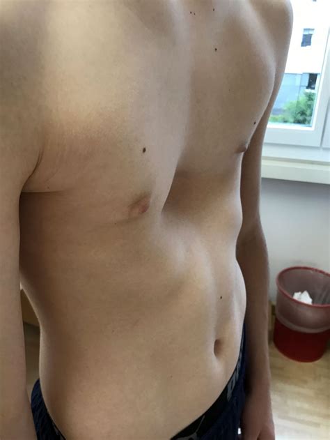 If the condition is severe, it can look like the middle of the chest is scooped out, creating a deep hole. Pectus Excavatum: First-in-human trial of novel ...