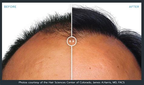 There are so many factors that change the size and scope of a hair transplant. Artas Robotic Hair Restoration Before And After Photos ...