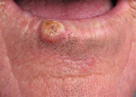 And physician s experience springerlink clinical challenge a lip lesion and history of basal cell carcinoma mpr squamous cell carcinoma lower lip skin cancer and reconstructive surgery center basal cell carcinoma on lip of an 86 year old woman patient care online. skincancerphysician: Skin cancer: Squamous cell carcinoma