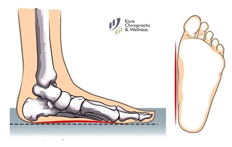 The muscles at the top of the foot fan out to supply the individual toes. The most obvious symptom of #overpronation is flattened foot arches. 👣 While many people with # ...