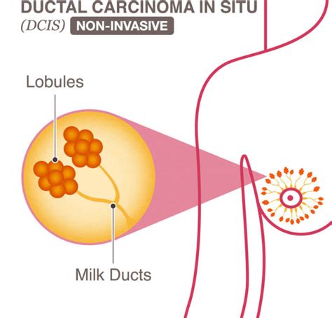 A universal tumor marker, with the ability to detect any type of cancer, has not been found. Ductal Carcinoma In Situ (DCIS) - National Breast Cancer ...