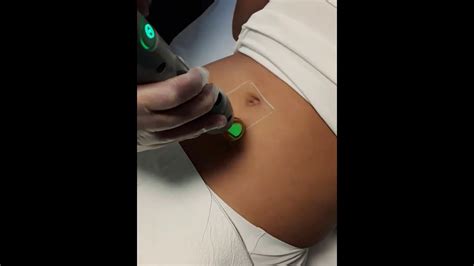 If you do not want to deal with stomach hair in the long run, get your hair removed with laser treatments, which use a pulse of light to destroy hair follicles. Laser Remedy Hair Removal: Abdomen Trail - YouTube