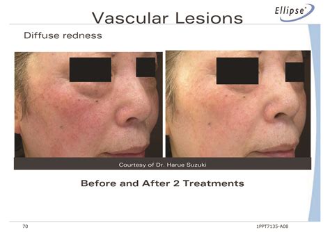 Burns, permanent changes to your skin color, and scars can occur. Thread Vein Treatment using Ellipse I2PL | Beauty Haven ...