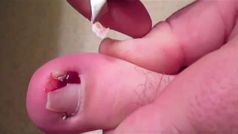 Swelling around the ingrown edge. Infected Ingrown Toenail Surgery - YouTube