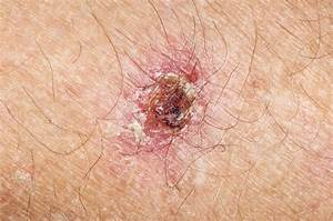 Skin cancer - Stock Image - F002/9962 - Science Photo Library Skin Cancer  