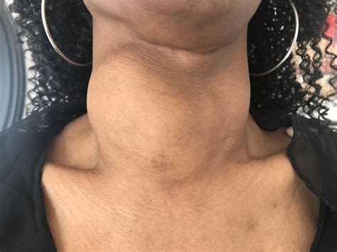 Most thyroid nodules are found during a routine physical exam. Dr. Sonoo Advani | Thyroid Nodules - Dr. Sonoo Advani