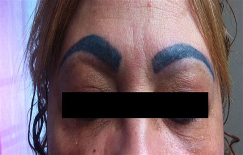 Of course, the more primitive methods tend to be much more painful and more likely to cause severe scarring, but they actually get rid of the tattoo itself fairly well. Bad Permanent Makeup & Tattoos - Tattoo Removal A+ Ocean Blog