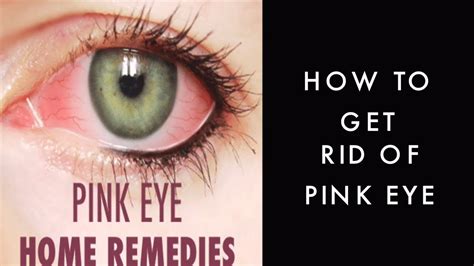 Do you have red eyes, how did you get rid of them? How To Get Rid Of Pink Eyes - Nutshell School - YouTube