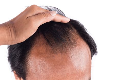 Think of masturbation as a chemical reaction that unleashes a bevy of hormones, proteins and neurotransmitters. How to Stop Hair Loss and Hair Thinning: 6 Effective Steps