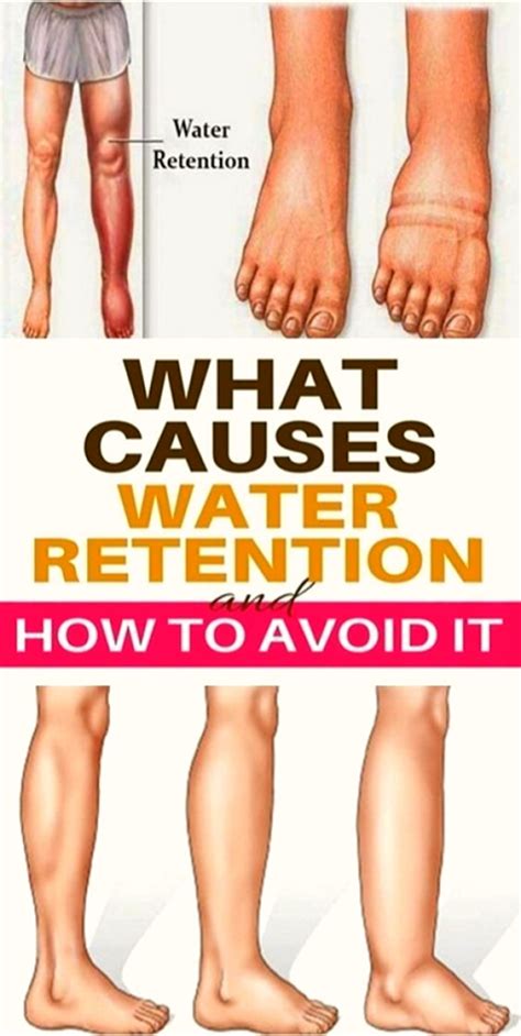 What is remedies fluid retention symptoms fluid retention in abdomen fluid retention ankles fluid retention in fingers reduce fluid retention getting rid of fluid retention body fluid retention during pregnancy retention natural therapy fluid retention edema dropsy causes of fluid retention in legs. Kidney Stone Symptoms Water Retention - kidneyoi