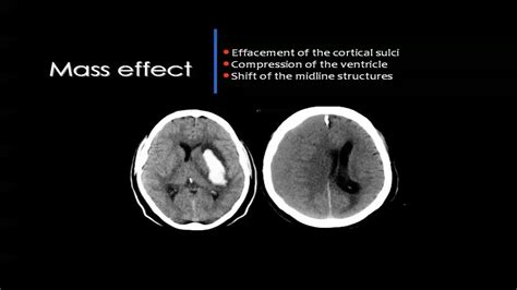 Some experts say alzheimer's disease will soon reach epidemic proportions. Pin de Dr abuaiad en brain&head and neck