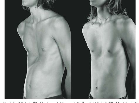 Pectus excavatum (pe) is a deformity of the chest wall characterized by sternal depression, which typically begins over the pectus excavatum: Figure 5 from The vacuum bell for treatment of pectus ...