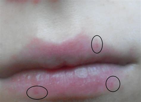 Die lippe gehört zu den unangenehmsten stellen, an denen sich pickel bilden können. Schwarze Mitesser am Lippenrand gehen nicht weg? (Beauty ...