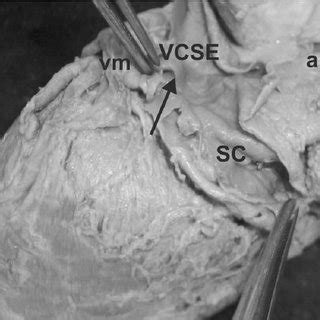Beginning with the superior and inferior vena cavae and the coronary sinus, the flowchart below summarizes the flow of blood through the heart, including all arteries, veins, and valves that are passed along the way. Dissection from the heart with the atresia of the coronary ...