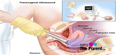 A pregnancy can be seen on scan from as early as 6 weeks from the first day of your last period (lmp). Transvaginal Scans During Early Pregnancy | Being The Parent