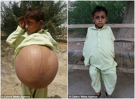 Une belle petite idée cadeau ! Ce garcon de 9 ans souffre d'une maladie rare qui le laisse avec le ventre ballonné (PHOTOS ...