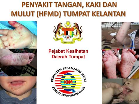 Pengobatan yang diberikan berupa diberikan perawatan untuk meredakan mencegah adalah lebih baik daripada mengobati. PPT - PENYAKIT TANGAN, KAKI DAN MULUT (HFMD) TUMPAT ...